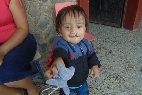 Selvin, age 1 year, plays with a little stuffed animal as he waits for a Surgical Referral for his Cleft Lip